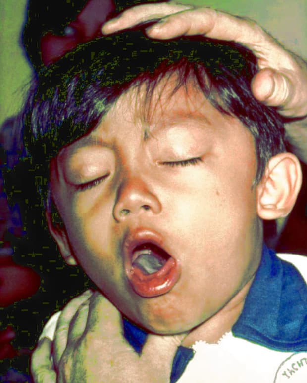 key-information-about-whooping-cough