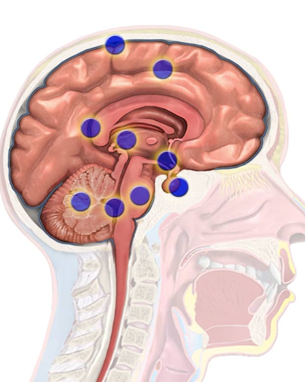 key-information-about-brain-tumor