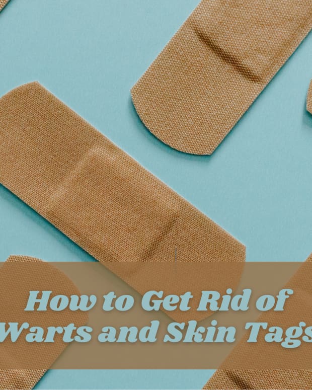 how-to-remove-skin-tags-and-warts-on-your-genitals-or-other-parts-of-your-body-naturally