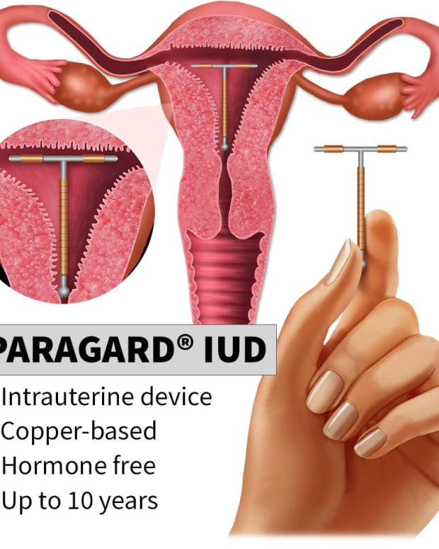 is-paragard-the-hormone-free-alternative-to-birth-control-pills