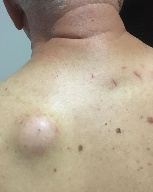 treatment-for-my-sebaceous-cyst
