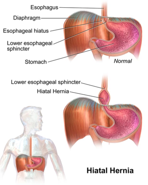 hiatal-hernia-facts