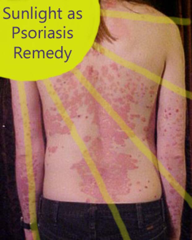 light-therapy-for-psoriasis＂>
                </picture>
                <div class=