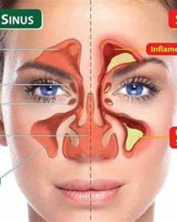 effective-home-remedies-to-prevent-the-risk-of-nasal-or-sinus-infection-sinusitis