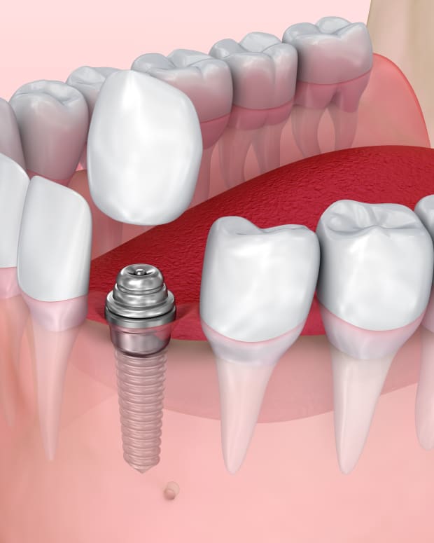 the-advent-of-the-dental-implant