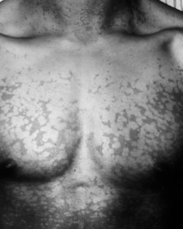 Tinea versicolor on a man's chest.
