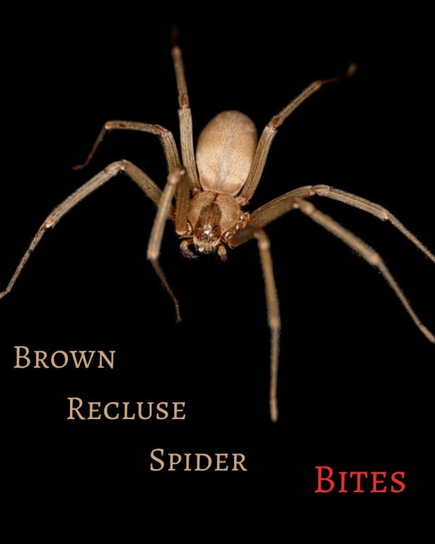 brown-recluse-spider-bite-pictures-stages-symptoms-causes-treatment