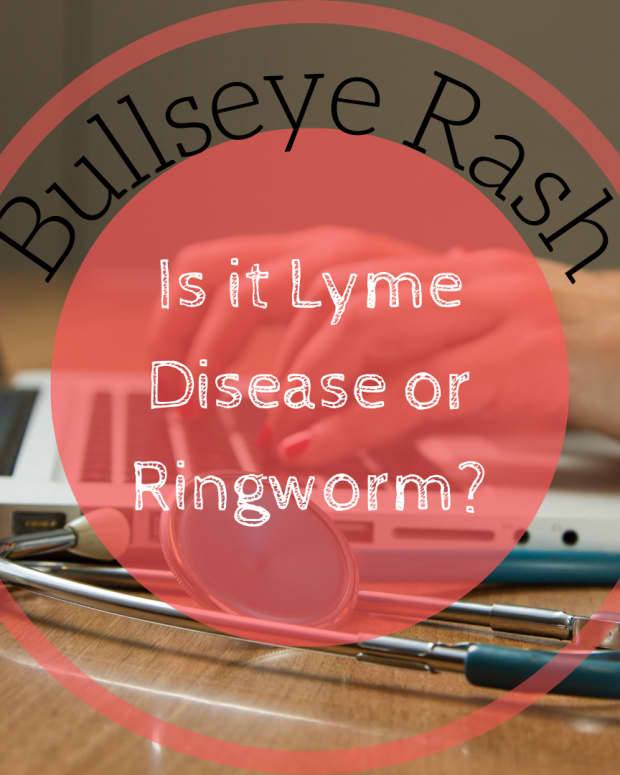 ringworm-vs-lyme-disease-how-to-tell-the-difference-between-the-bulls-eye-rash
