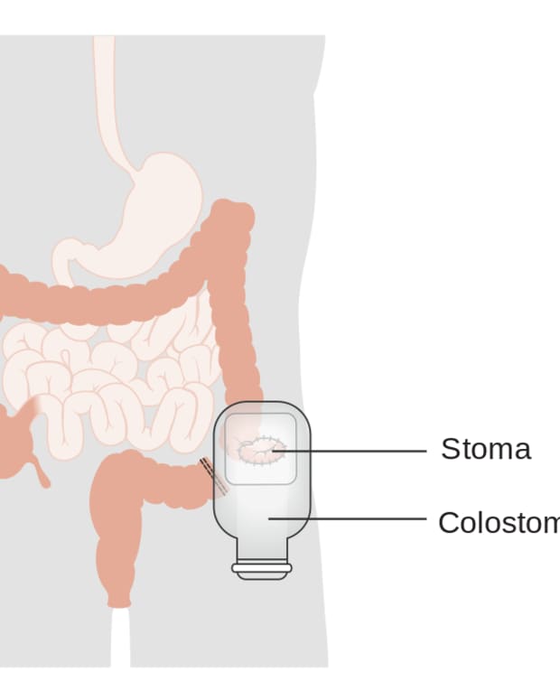 colostomy_managing-colostomy_after-colon-surgery