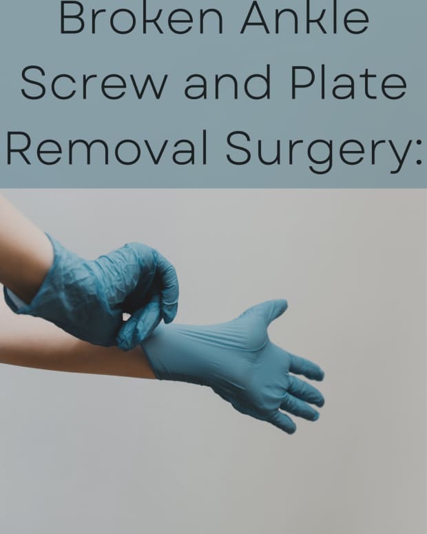 broken-ankle-plate-screw-removal-surgery