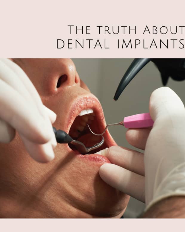 dental-implants-what-dentists-dont-tell-you-can-hurt