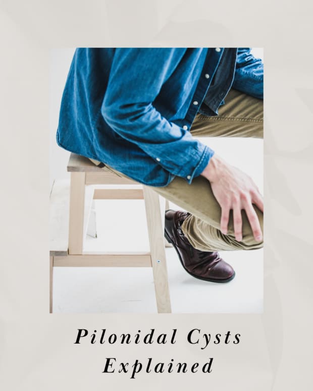 pilonidal-cyst-what-the-heck-is-that