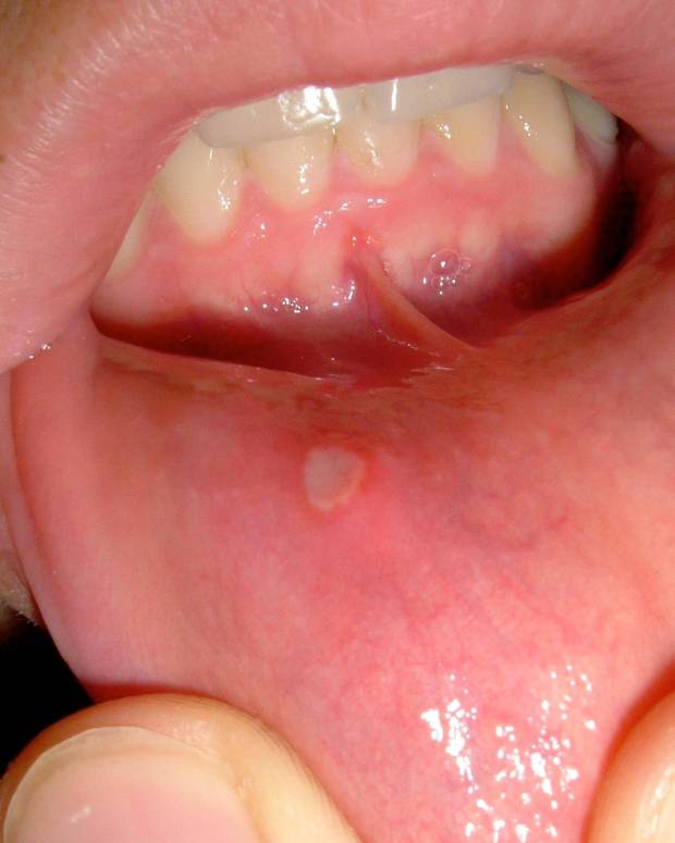 Try Baking Soda for Canker Sore Relief HubPages