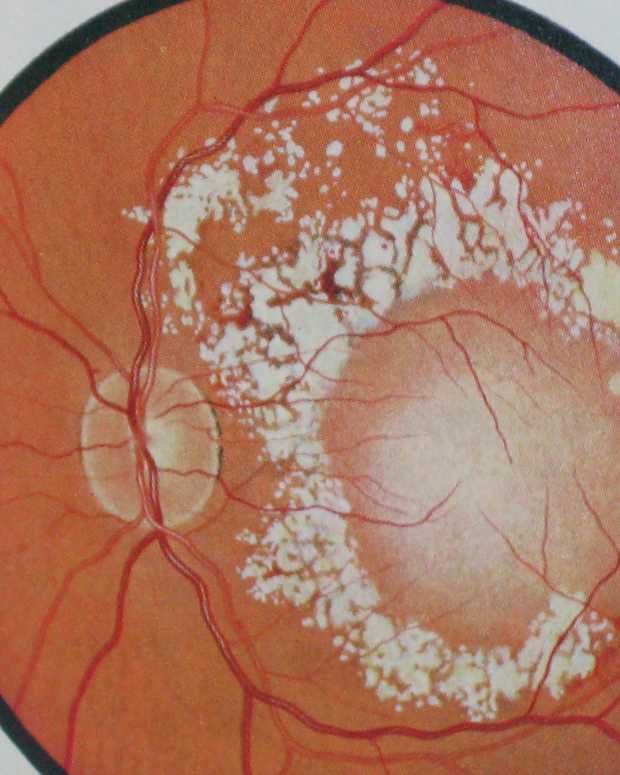 Macular Degeneration