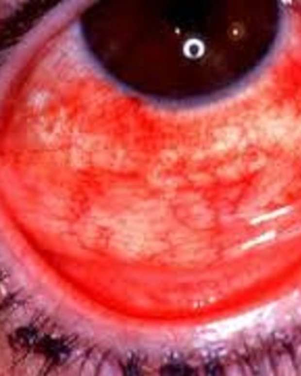 adeno-viral-kerato-conjunctivitis