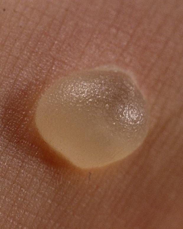 How to Treat a Cold Pack Burn RemedyGrove Holistic Wellness