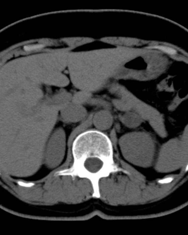 CT Scan of the Abdomen and Pelvis With and Without Contrast