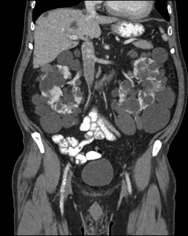 what-is-the-contrast-dye-used-in-ct-scans-healthproadvice