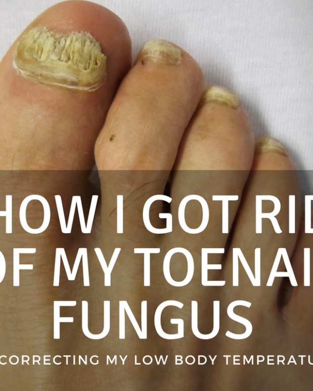 How I Used Lamisil to Successfully Treat My Toenail Fungus Patient's