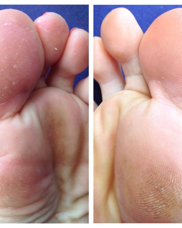 7 Easy and Effective Home Remedies for Athlete's Foot RemedyGrove