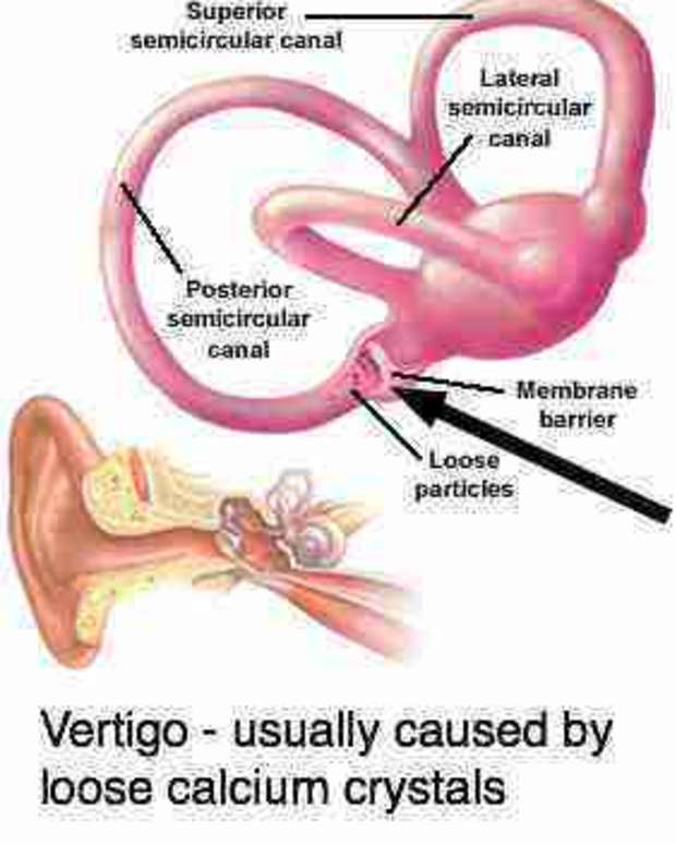 vertigo-is-scary-and-often-unexpected-when-it-hits-you