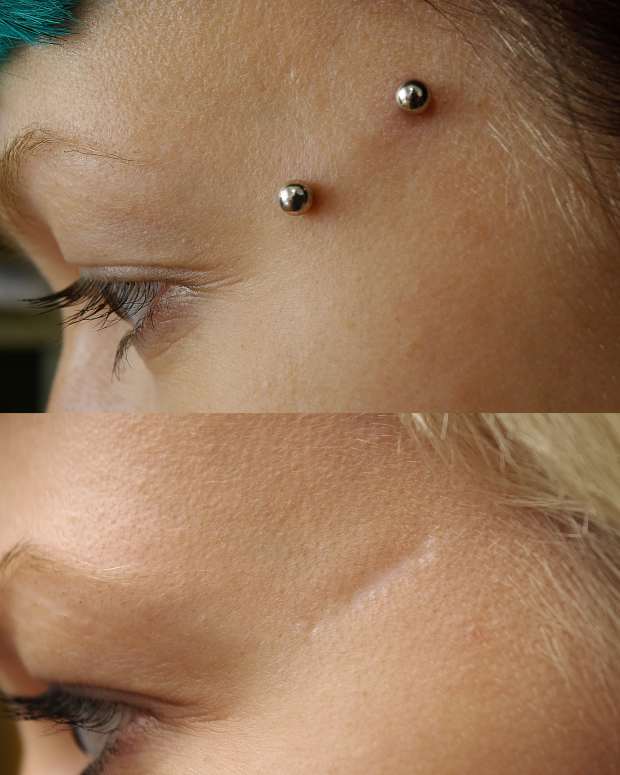 Dermal Piercing—Pictures, Care, Procedure, Types, Scars Removal