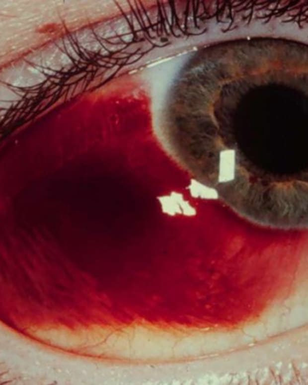 Causes Of A Red Spot On Eye Youmemindbody