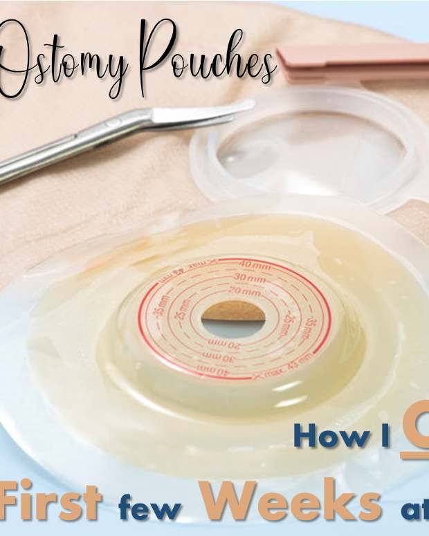 Advantages and Disadvantages of Disposable Colostomy Bags Patient's