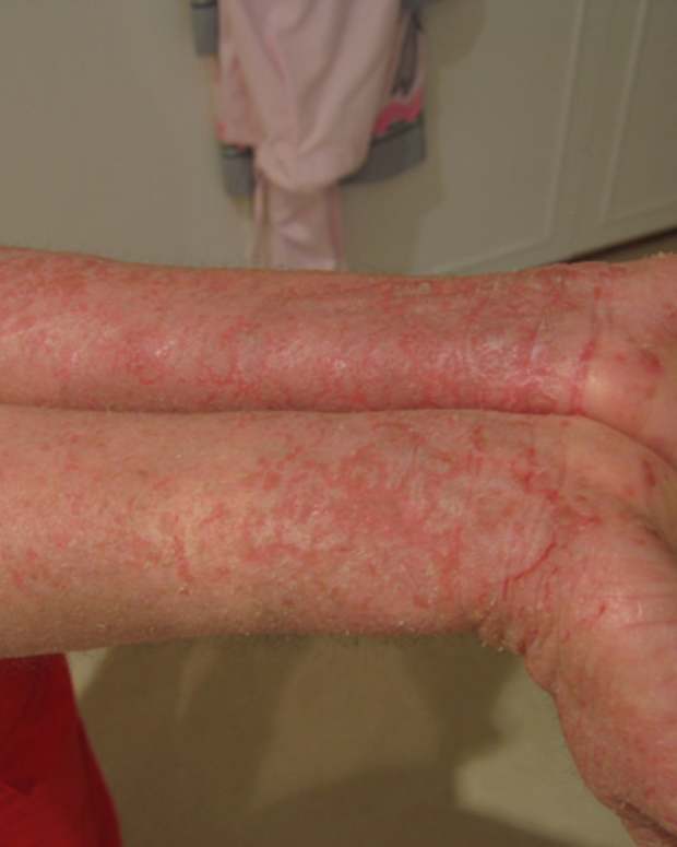 clot solar red on feet