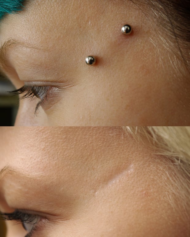 Dermal Piercingpictures Care Procedure Types Scars Removal Infection Tatring Tattoos