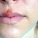 Herpes labialis (oral herpes) around the mouth..
