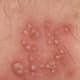 Herpes blisters are clear, white, or yellow and are filled with clear liquid. They lie right on the surface of the skin.