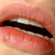 Herpes labialis (oral herpes) on the lips.