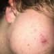 The later stages of pimple development in which they begin to dry out and heal. There may still be some discoloration where the pimple used to be.