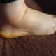 This is a foot swollen in a state of edema.