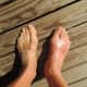 This foot is swollen because of gout, a form of arthritis. For recurring swelling, see a physician.