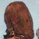 Cancerous lung