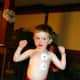 After our son's first supraglottoplasty, at age 3: recovering at home.