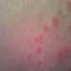 Here is itchy Pityriasis rosea hanging out on my right thigh.