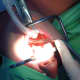 what-to-expect-with-an-adult-tonsillectomy