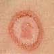 It can be tricky to tell the difference between Lyme and ringworm. A doctor can take a skin cell sample and send it to the lab for evaluation. 