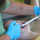 Putting the glue on the teeth for the brackets.
