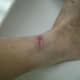 8/25/2012. This was the healing progress after starting the antibiotic Ciprofloxacin, Dakin's Solution soaks, and application of the silver carbon fiber.