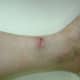9/7/2012. I experienced stinging and pain from the nerve repair. My circulation returned to the area.