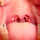 A pair of tonsils with a tonsillolith in the left side.