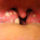 A severe case of tonsillitis.  Notice the many tonsilloliths in both tonsils!