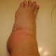 Severe Edema of Whole Body or Localized Areas is Common