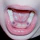 Forty-eight hours after the tooth extraction, the holes are starting to heal. The hole for the incisor is almost gone, since that tooth had been wiggly (it's root was partially dissolved already)