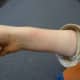 Once the test is complete, the patient's arm may be red. The redness will dissipate over the course of the day. 