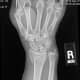 My broken wrist.